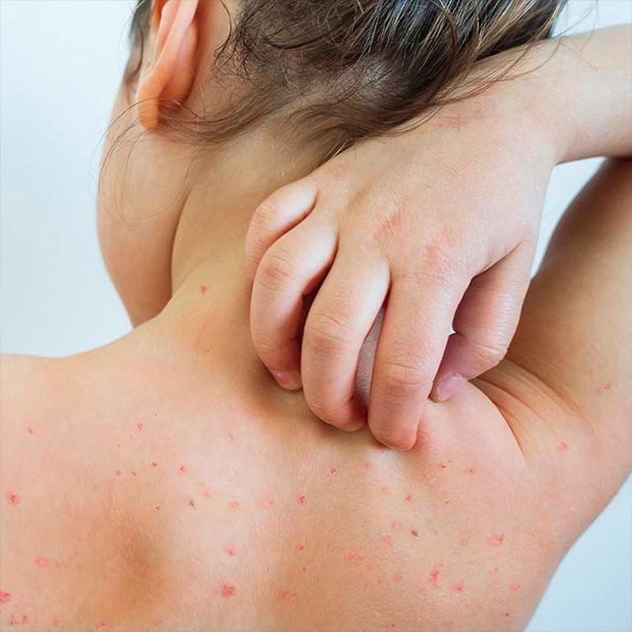 علت ایجاد آبله مرغان